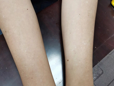 特發性滴狀色素減少症胳膊有白點圖 特發性滴狀色素減少症胳膊有白點圖