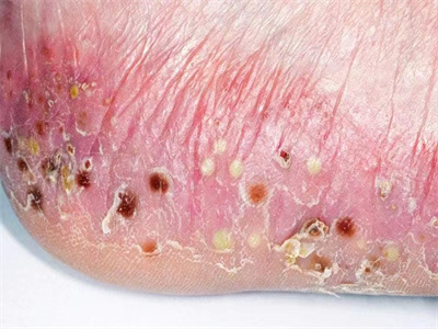局限性膿皰型銀屑病腳部膿包結痂圖