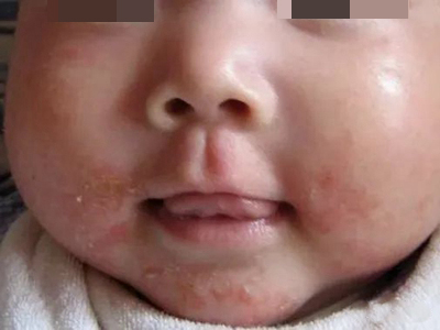 口周濕疹口周有紅色疹子圖 口周濕疹口周有紅色疹子圖