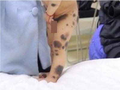 獸皮痣腿上有好幾塊卵圓形的黑斑圖 獸皮痣腿上有好幾塊卵圓形的黑斑圖