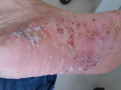 皰疹樣膿皰病腳底白色膿包伴結痂圖 皰疹樣膿皰病腳底白色膿包伴結痂圖
