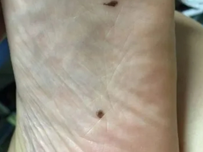 良性幼年黑素瘤腳底有兩個黑痣圖 良性幼年黑素瘤腳底有兩個黑痣圖