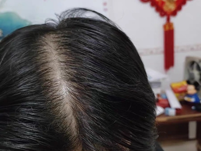 雄激素性脫髮頭髮稀疏發縫變大圖