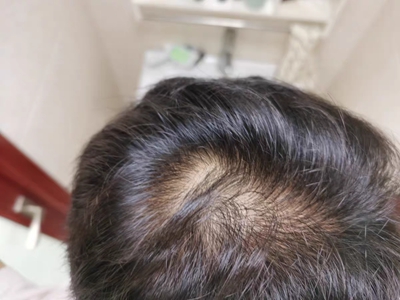 雄激素性脫髮頭頂中間頭髮稀疏圖