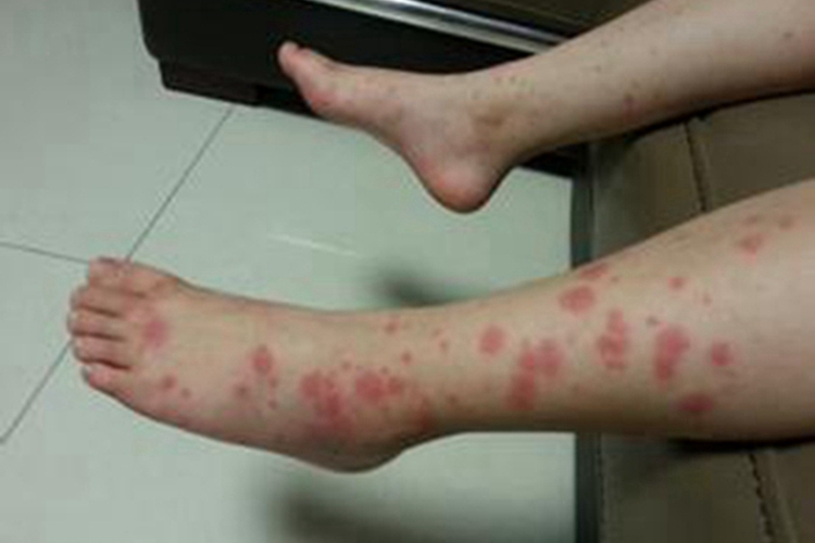 小兒過敏性紫癜左側小腿有紅斑圖
