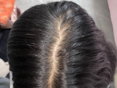 女性型脫髮頭頂中間發縫很寬圖 女性型脫髮頭頂中間發縫很寬圖