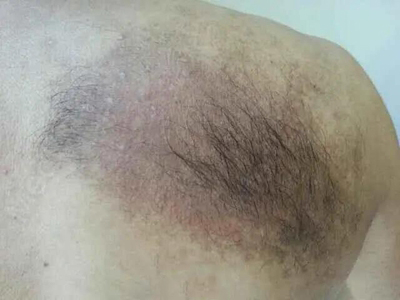 色素性毛表皮痣後背長斑長毛圖