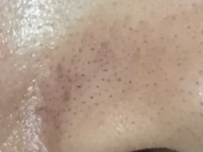 小棘毛壅病鼻翼上小黑點樣丘疹圖