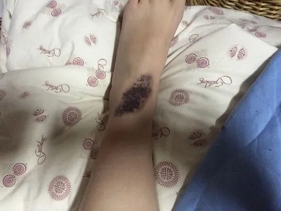 獸皮痣腳部有一片像樹葉一樣的黑斑圖 獸皮痣腳部有一片像樹葉一樣的黑斑圖