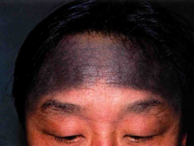 瑞爾黑變病額頭有一片黑色的斑圖