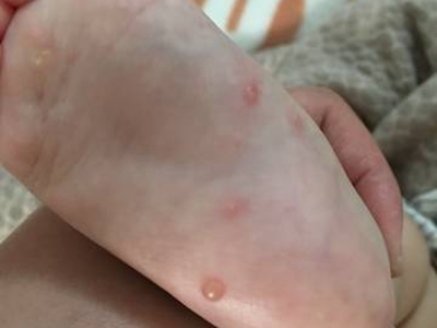 嬰兒肢端膿皰病腳底起了幾個水皰圖