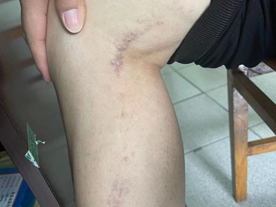 線狀苔蘚膝蓋側緣出現灰粉色疙瘩圖 線狀苔蘚膝蓋側緣出現灰粉色疙瘩圖