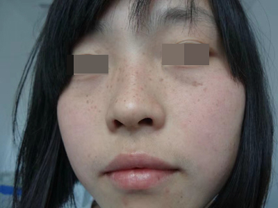 雀斑面部長了很多褐色的斑點圖