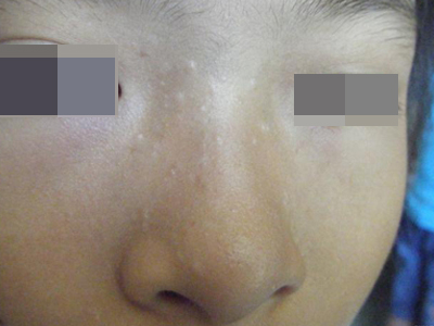 多發性毛髮上皮瘤鼻子上有小疹子圖