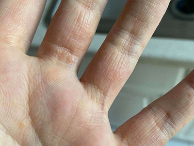手部濕疹手指根部起淡黃色小水皰圖 手部濕疹手指根部起淡黃色小水皰圖