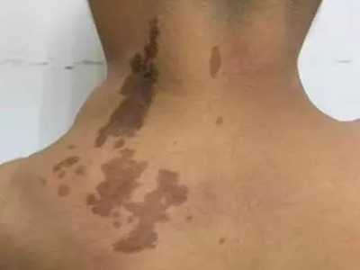 咖啡斑後脖子後面有多個深咖啡色斑圖