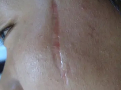 萎縮性瘢痕面部凹進去的長條瘢痕圖