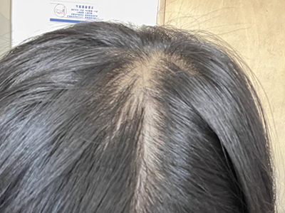 雄激素性脫髮頭頂露出寬大的發縫圖 雄激素性脫髮頭頂露出寬大的發縫圖