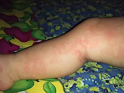 蠓蟲叮咬引起的皮膚反應長疙瘩圖 蠓蟲叮咬引起的皮膚反應長疙瘩圖