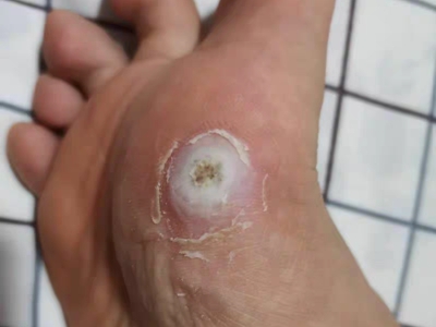 胼胝腳底有個脫皮的白色硬疙瘩圖