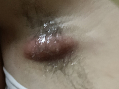 皮脂腺囊腫腋窩有一個紅色大包塊圖 皮脂腺囊腫腋窩有一個紅色大包塊圖