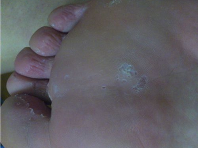 溝狀跖部角質松解症腳底好幾個小坑圖 溝狀跖部角質松解症腳底好幾個小坑圖