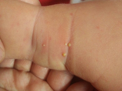 新生兒膿皰瘡腋窩有幾個黃色小膿包圖