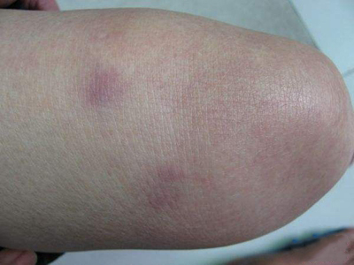 人工性脂膜炎大腿有兩塊紫紅色硬斑圖