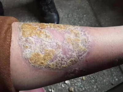 泛發性膿皰型銀屑病小腿有大塊脫屑圖 泛發性膿皰型銀屑病小腿有大塊脫屑圖