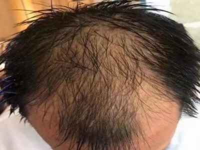男性型脫髮頭頂頭髮稀少頭皮油膩圖 男性型脫髮頭頂頭髮稀少頭皮油膩圖