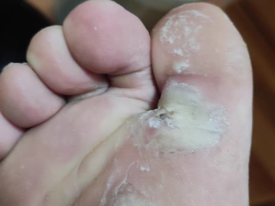 胼胝腳底有兩個發黃的斑塊破了起皮圖 胼胝腳底有兩個發黃的斑塊破了起皮圖