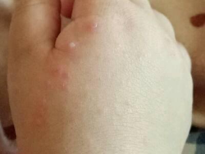 嬰兒肢端膿皰病手背紅色丘疹和水皰圖 嬰兒肢端膿皰病手背紅色丘疹和水皰圖