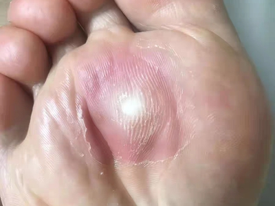 胼胝腳底有一大塊紅斑中間有硬疙瘩圖 胼胝腳底有一大塊紅斑中間有硬疙瘩圖