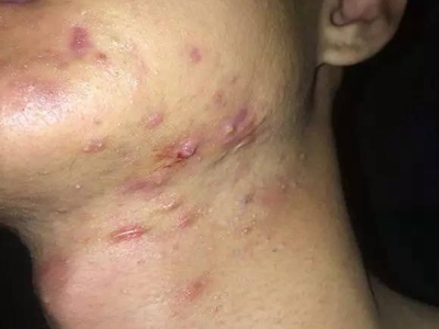 嗜酸性膿皰性毛囊炎下巴紫紅色結節圖 嗜酸性膿皰性毛囊炎下巴紫紅色結節圖