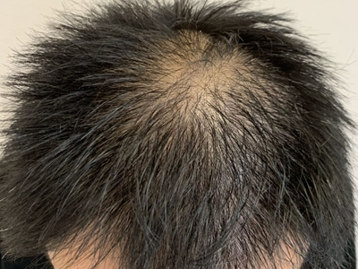 雄激素性脫髮頭頂頭髮稀疏圖 雄激素性脫髮頭頂頭髮稀疏圖