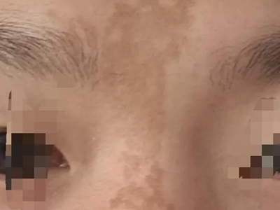 咖啡斑額頭上有不規則的淺咖啡色斑圖 咖啡斑額頭上有不規則的淺咖啡色斑圖