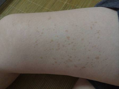 網狀肢端色素沉著大腿上有很多褐斑圖 網狀肢端色素沉著大腿上有很多褐斑圖