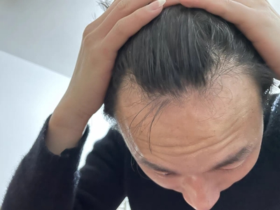 雄激素性脫髮兩側額角禿了額頭變高圖 雄激素性脫髮兩側額角禿了額頭變高圖