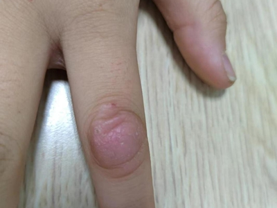 局限性神經性皮炎手指局部腫脹紅斑圖 局限性神經性皮炎手指局部腫脹紅斑圖