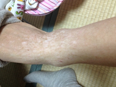 貧血痣腳背白了一片圖 貧血痣腳背白了一片圖