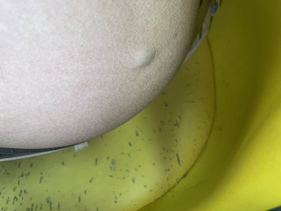 皮脂腺囊腫臀部有花生豆大小的疙瘩圖 皮脂腺囊腫臀部有花生豆大小的疙瘩圖