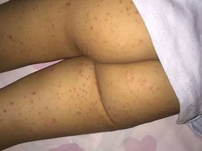 小兒過敏性紫癜臀部散在很多小紅點圖 小兒過敏性紫癜臀部散在很多小紅點圖