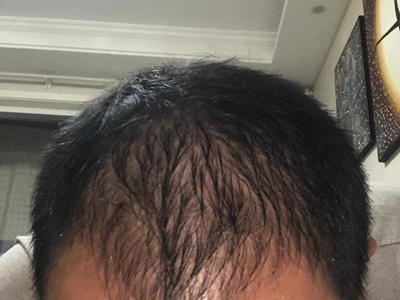 雄激素性脫髮頭髮變少還一束一束的圖 雄激素性脫髮頭髮變少還一束一束的圖