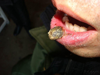 愛滋病皮膚腫瘤嘴唇邊有黑褐色結節圖 愛滋病皮膚腫瘤嘴唇邊有黑褐色結節圖