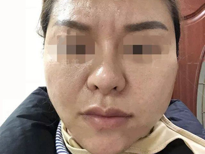 硬腫病面部又腫又僵硬圖