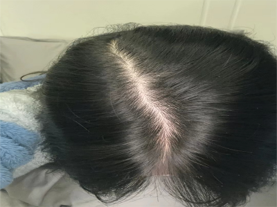 雄激素性脫髮頭髮減少露出白色頭皮圖 雄激素性脫髮頭髮減少露出白色頭皮圖