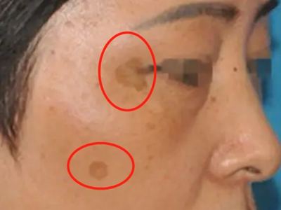 咖啡斑臉上有黃豆樣的圓形咖啡色斑圖 咖啡斑臉上有黃豆樣的圓形咖啡色斑圖