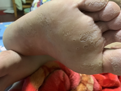 窩狀角質松解症腳底脫皮像蜂窩一樣圖 窩狀角質松解症腳底脫皮像蜂窩一樣圖