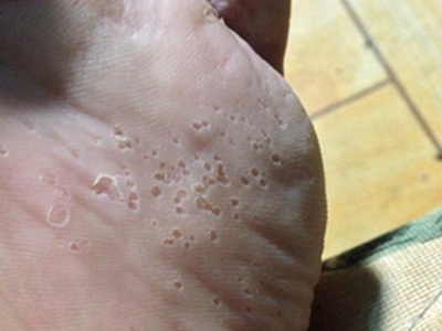 溝狀跖部角質松解症腳底脫皮有小坑圖 溝狀跖部角質松解症腳底脫皮有小坑圖