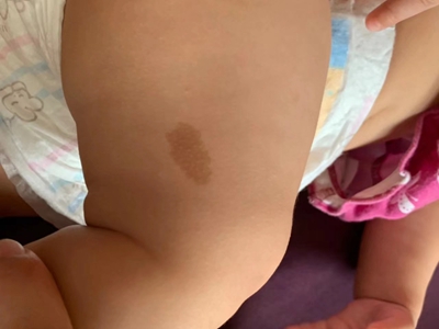 咖啡斑大腿上有很明顯的深咖色斑片圖 咖啡斑大腿上有很明顯的深咖色斑片圖